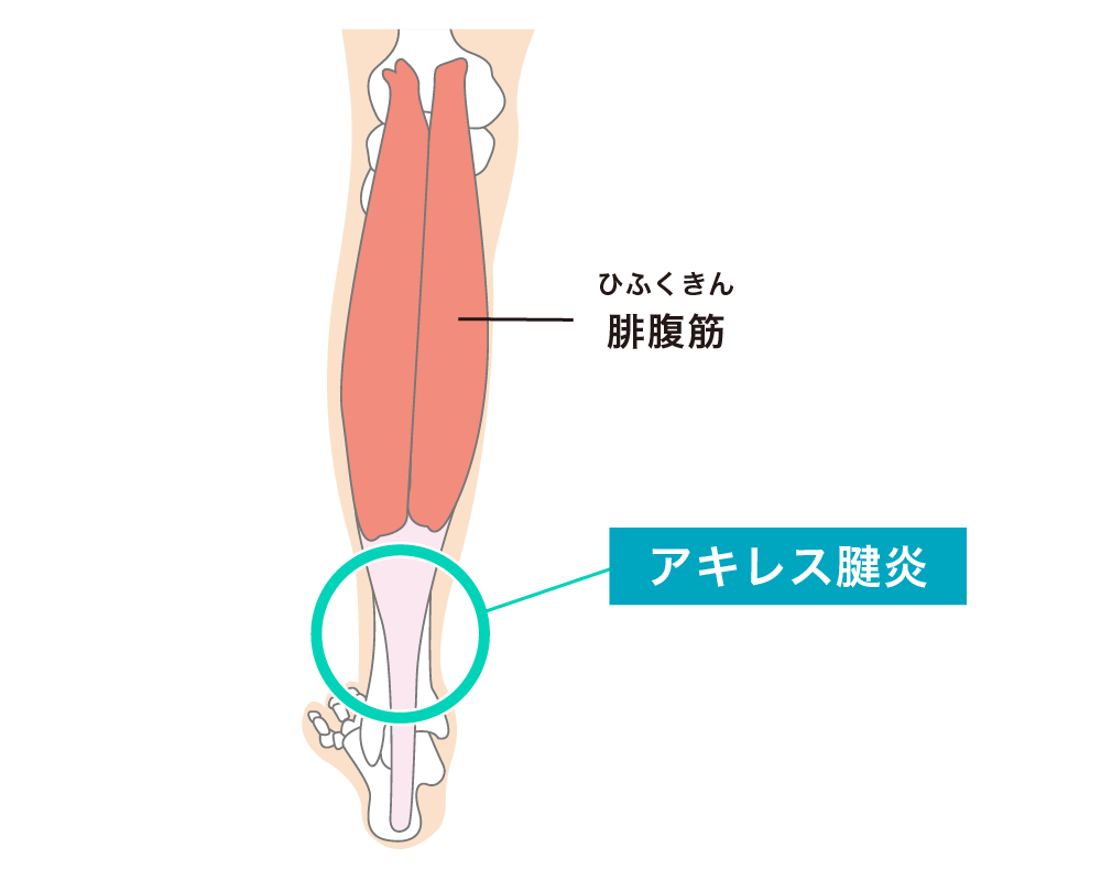 アキレス腱炎