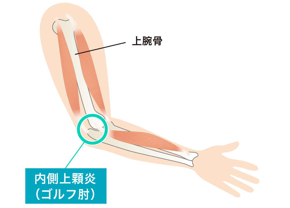 内側上顆炎（ゴルフ肘）