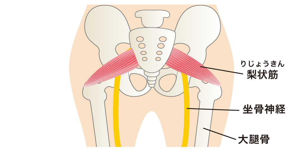 梨状筋症候群