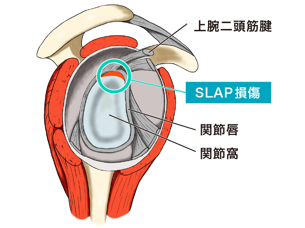 SLAP損傷