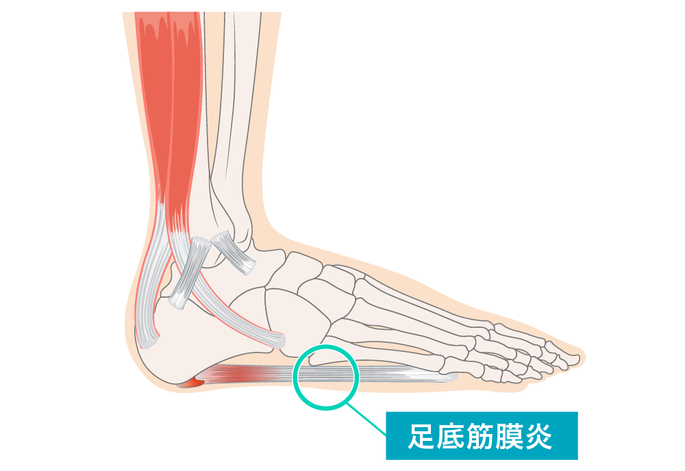 足底腱膜炎