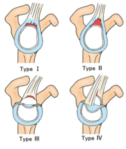 SLAP損傷　分類