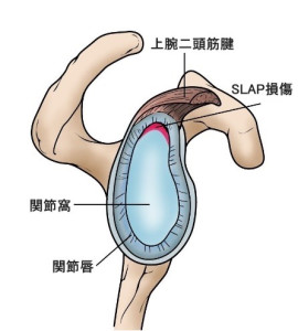 SLAP損傷　原因2