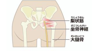 梨状筋症候群