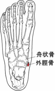 有痛性外脛骨