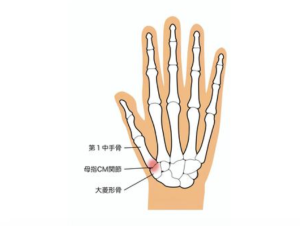 母指CM関節症