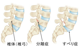 分離症4