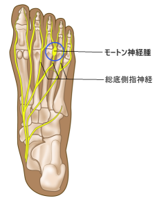 mortons-neuroma-plantar-dorsal