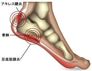 踵骨炎4