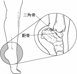 三角骨障害1