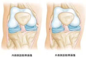 膝　側副靭帯2